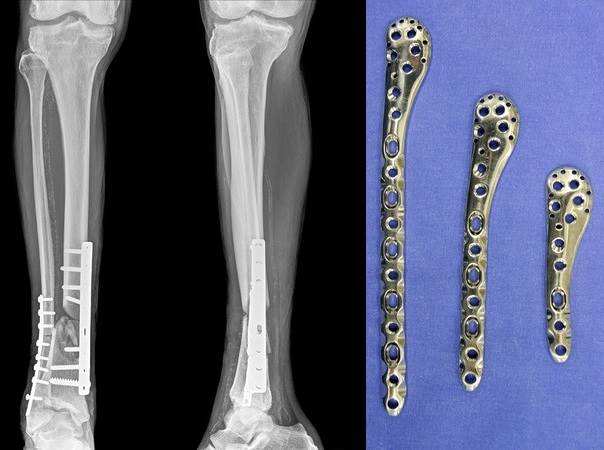 Internal plates and fracture.